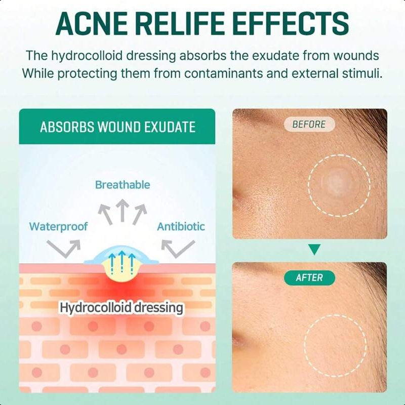 SOME BY MI 30 Days Miracle Clear Spot Patch - Pack Of 5, 90 Counts, 2 Size(10mm 45Counts, 12mm 45Counts)
