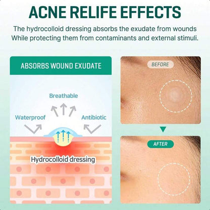SOME BY MI 30 Days Miracle Clear Spot Patch - Pack Of 5, 90 Counts, 2 Size(10mm 45Counts, 12mm 45Counts)