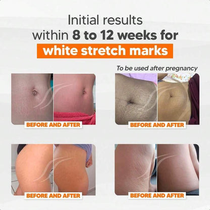 CICATRI Deep Stretch Mark Removal Cream 150ml/5.29 Oz - Innovative Formula With Pure And Powerful Natural Ingredients From Brazilian Flora - For All Stretch Marks & Skin Types.
