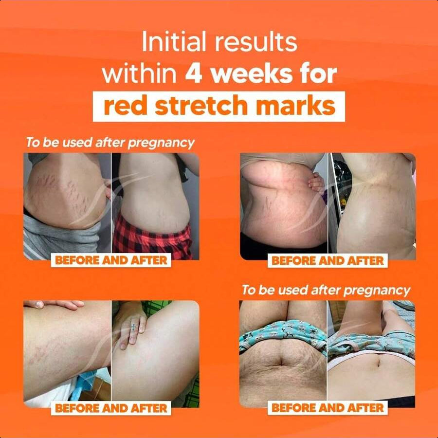 CICATRI Deep Stretch Mark Removal Cream 150ml/5.29 Oz - Innovative Formula With Pure And Powerful Natural Ingredients From Brazilian Flora - For All Stretch Marks & Skin Types.